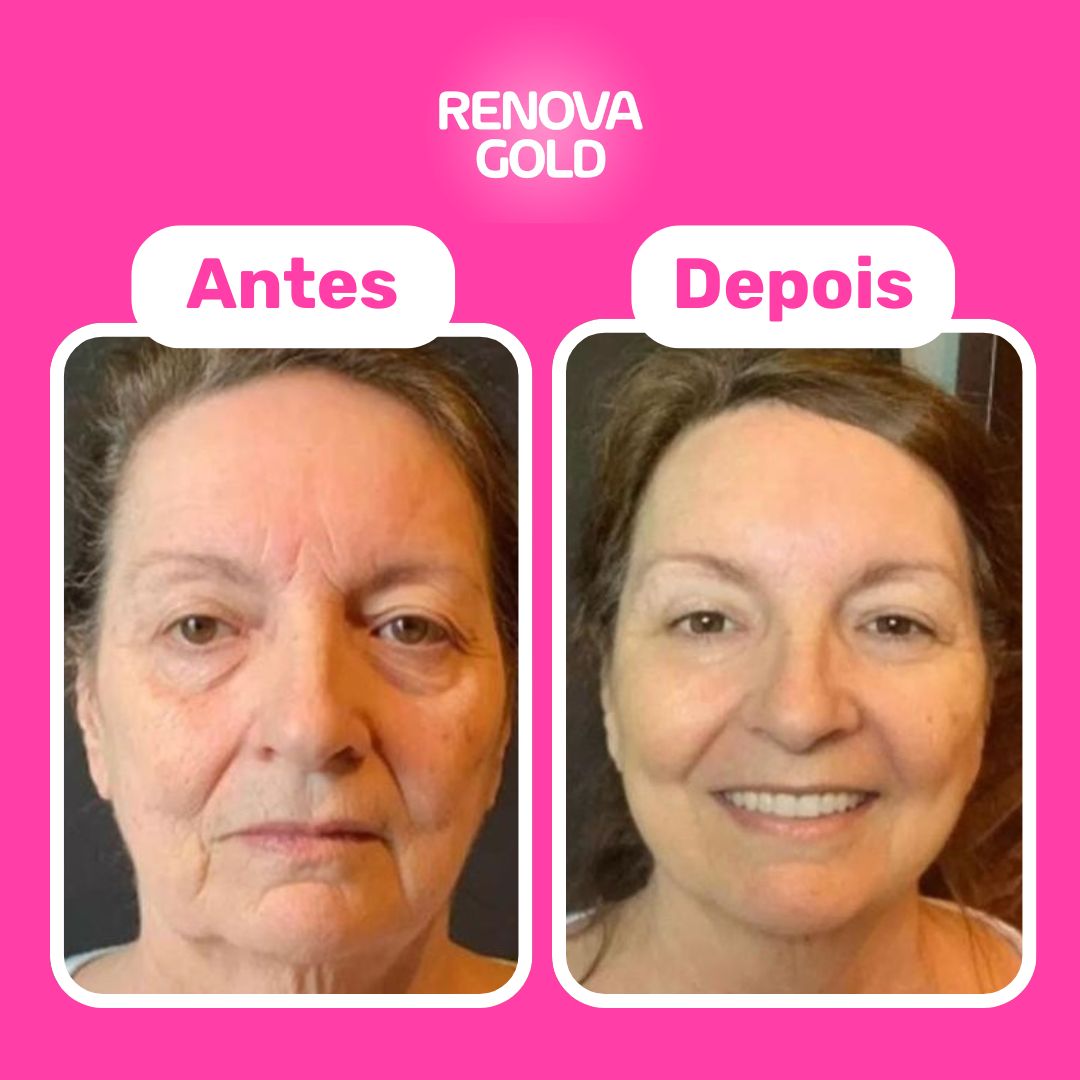 antes-depois-renova-gold