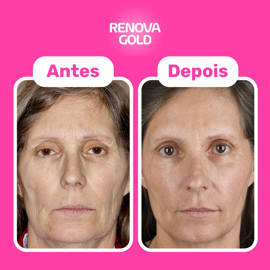 renova-gold-antes-depois