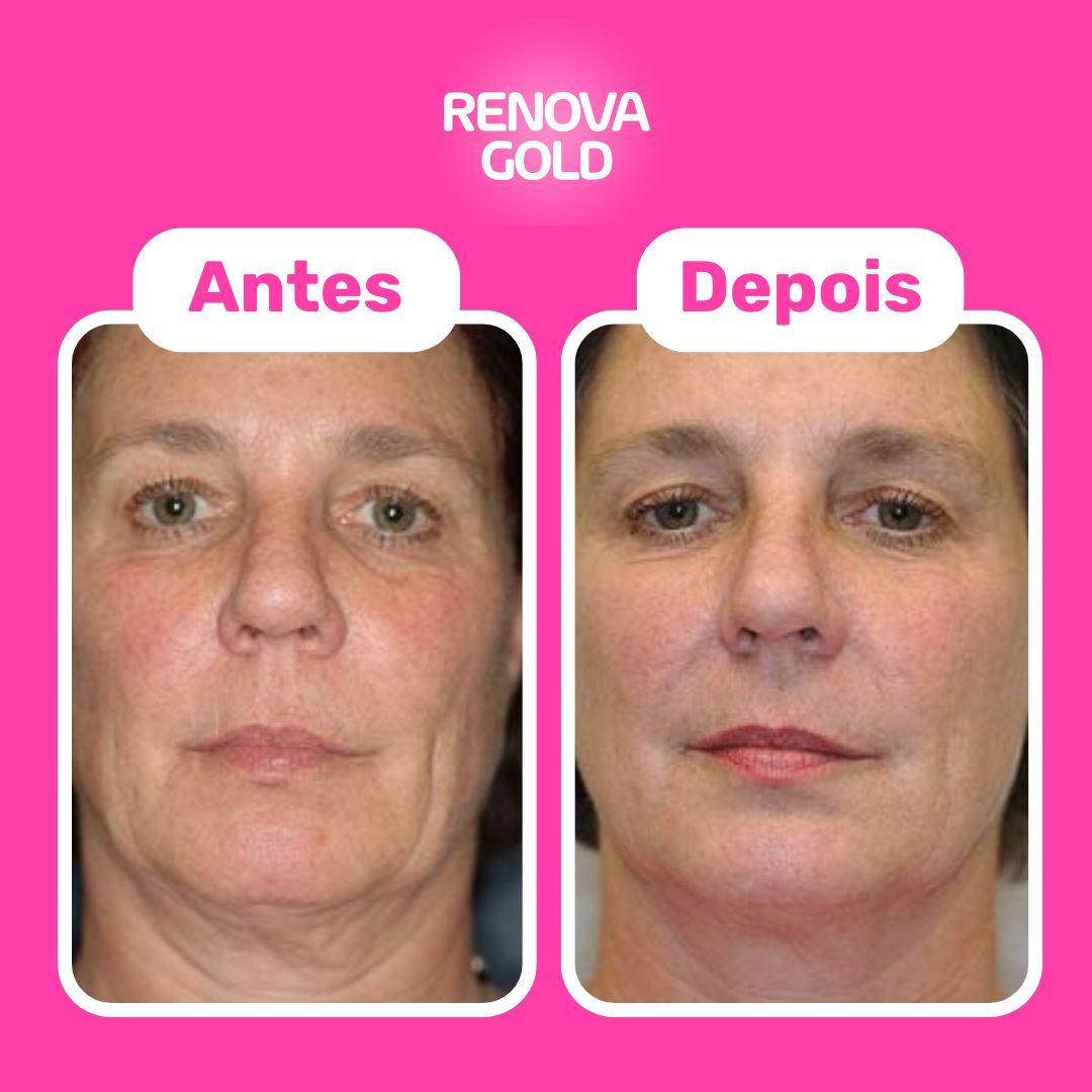 renova-gold-antes-e-depois-cliente